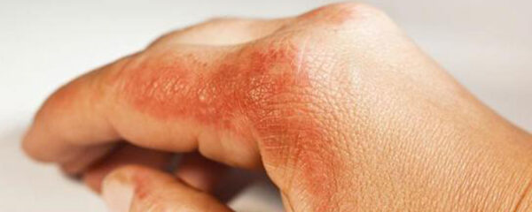 psoriasis en goutte