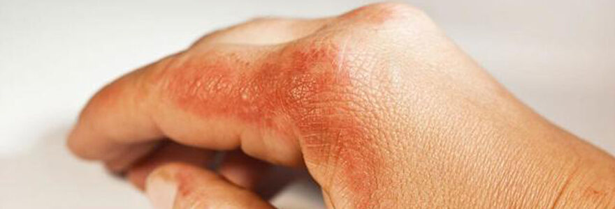 psoriasis en goutte